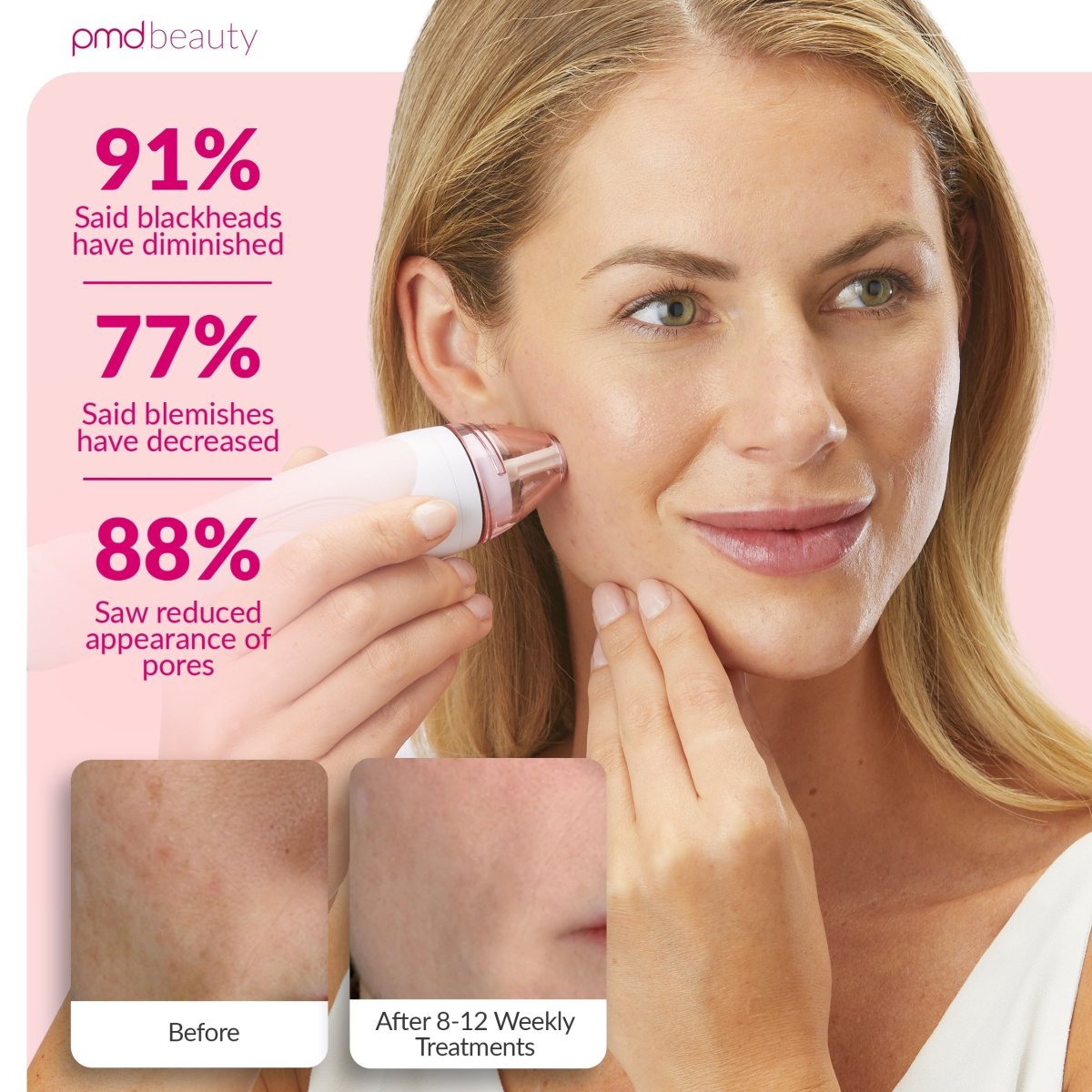 Personal Microderm Pro - International