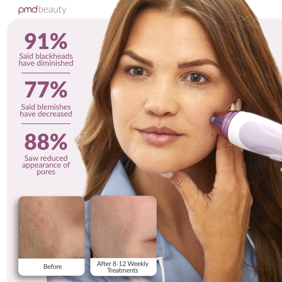 Personal Microderm Pro - International