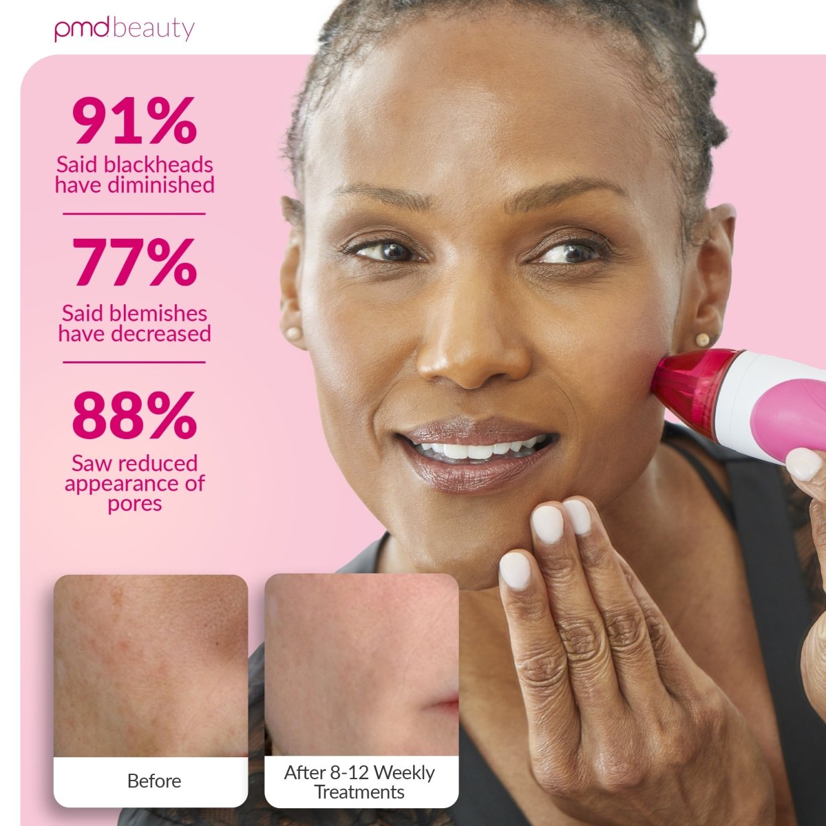 Personal Microderm Pro - International