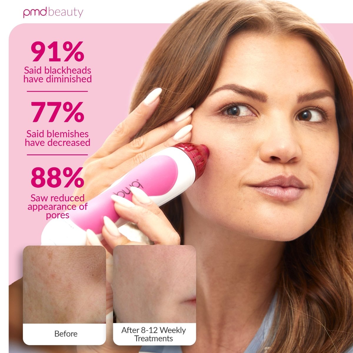 Personal Microderm Classic - International