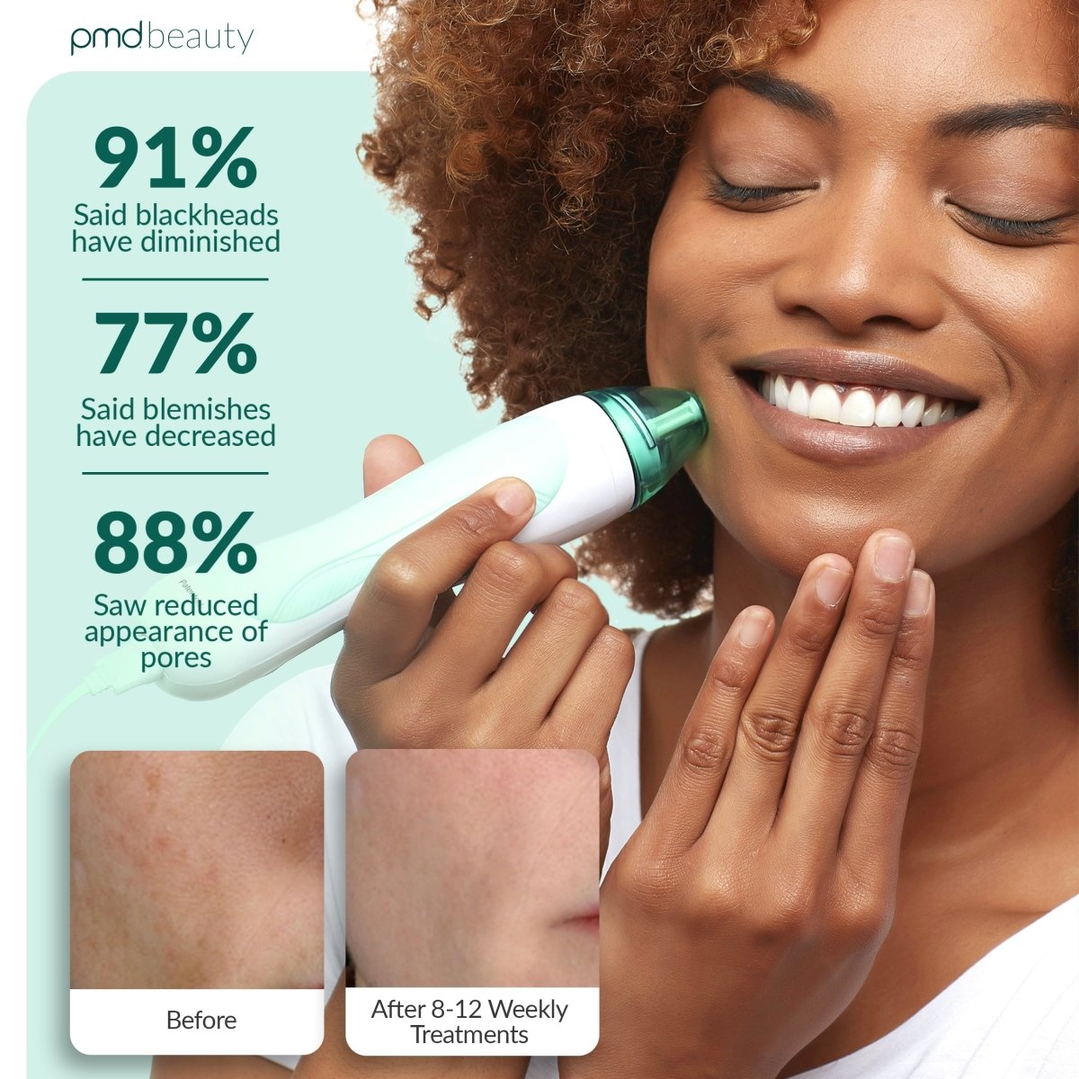 Personal Microderm Pro - International