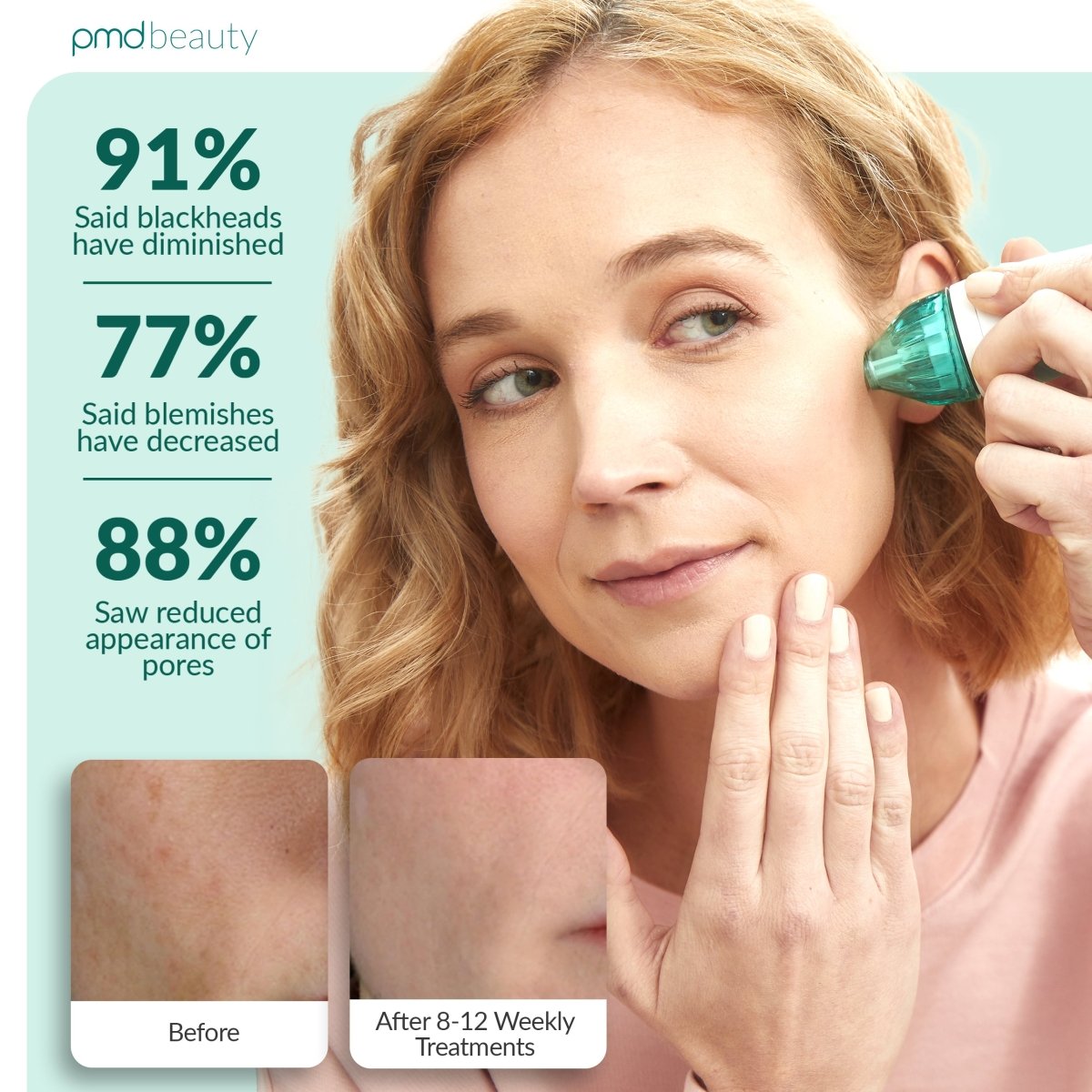 Personal Microderm Classic - International