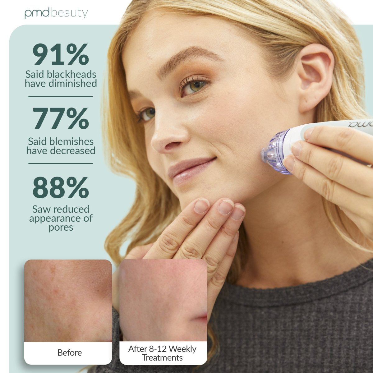 Personal Microderm Classic - International