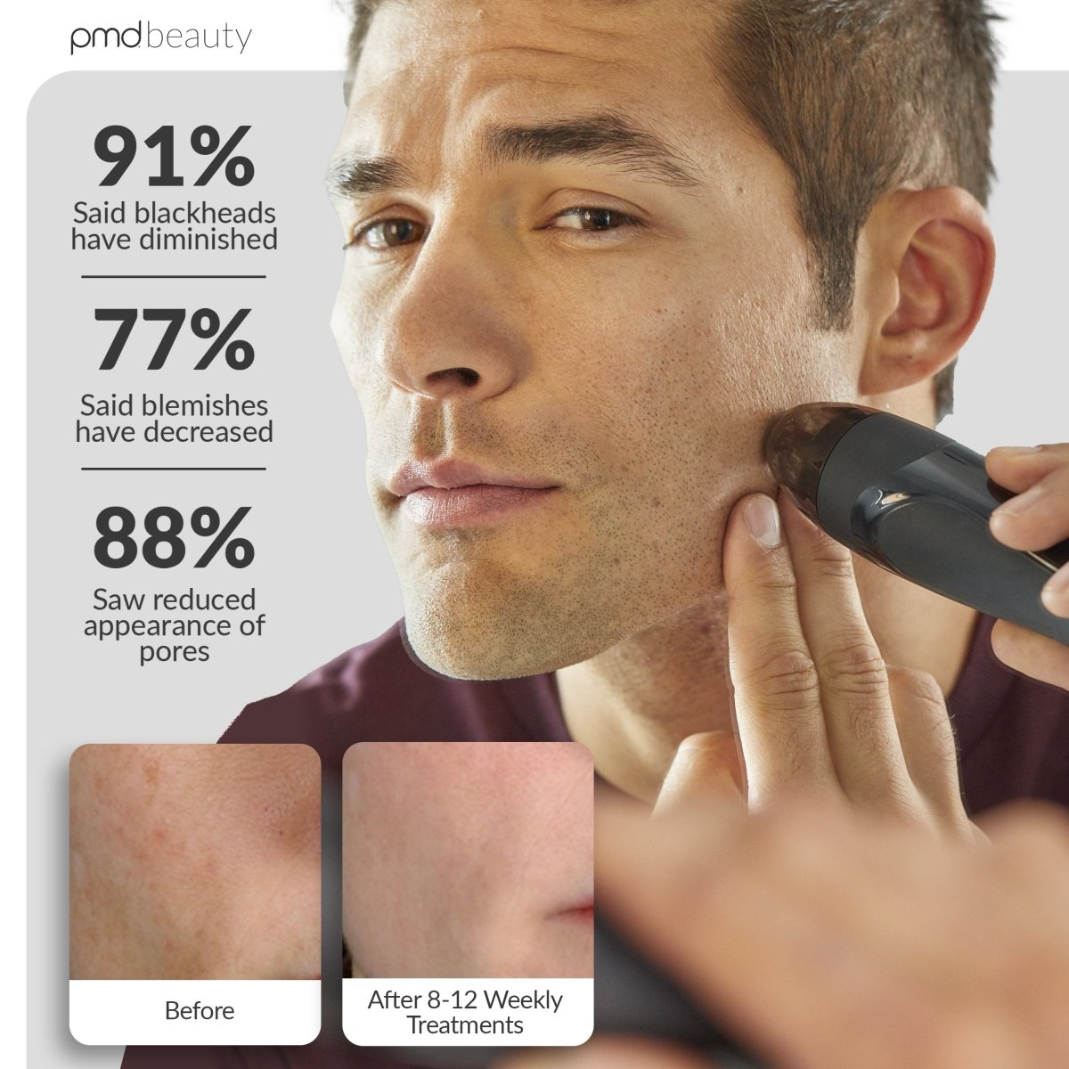 Personal Microderm Elite Pro - Black
