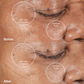 4001-Black-Metal?Clinical trial Before & After using the PMD Clean